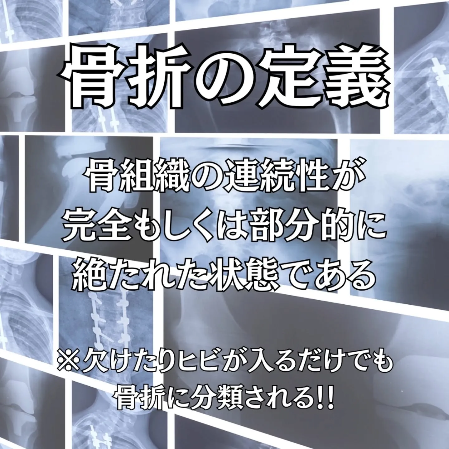 骨折は早期の正確な評価と適切な固定が、その後の機能回復を大き...