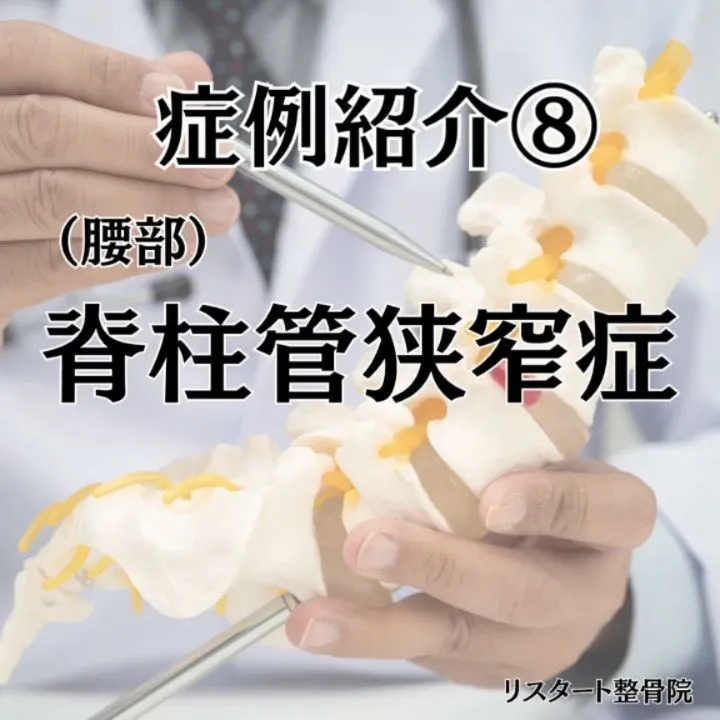 【歩くと足が痛む…それ「脊柱管狭窄症」かもしれません】