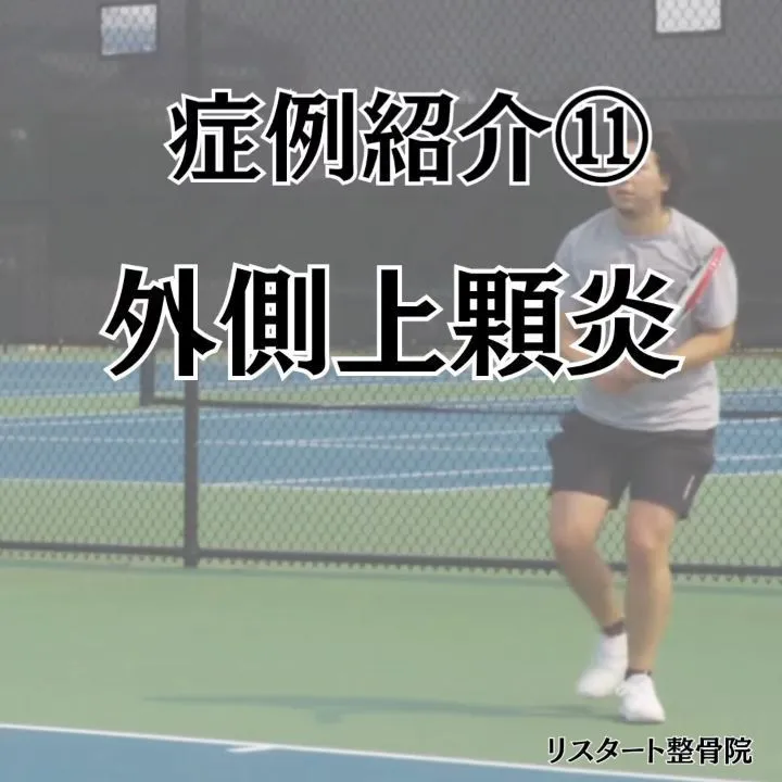 ​今回は、物を持ったときや手を動かしたときに肘の外側が痛む「...