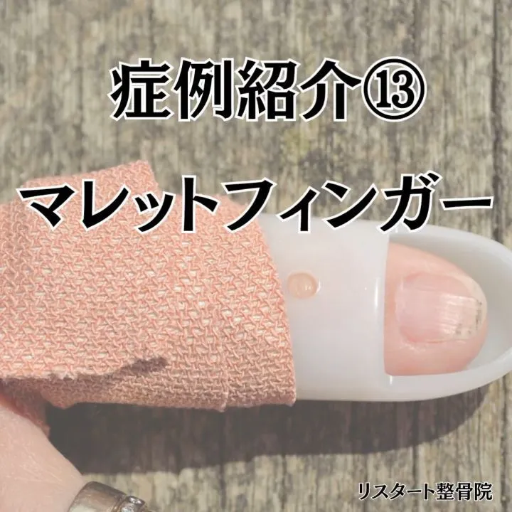 指が伸びなくなるリスクがある「マレットフィンガー」について解...